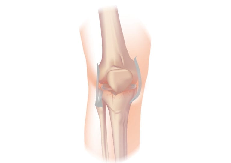  Diz osteoartritli hastalarda trombositten zengin plazmanın özelliklerini etkileyen faktörler