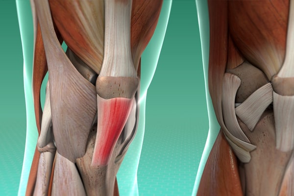 Bilateral Spontan Quadriceps Tendon Kopmaları Nedeniyle Transpatellar Tünel Tekniği ile Tedavi Edilen Hemodiyaliz Hastalarında Diz Gücü ve Dayanıklılığının İzokinetik Değerlendirmesi